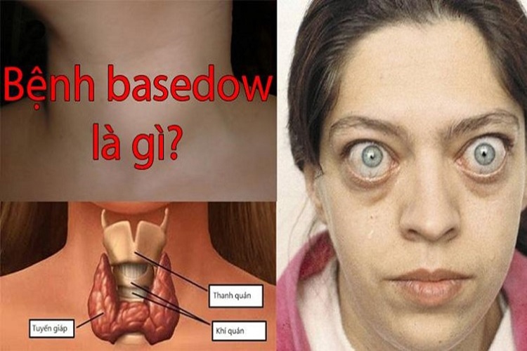 bệnh basedow