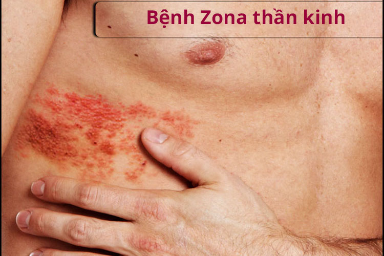 bệnh zona