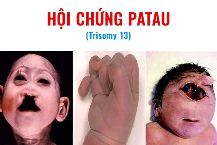 hội chứng patau